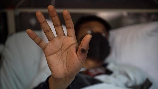 Mpox Virus Spreads Across 116 Countries, WHO Declares Global Health Emergency