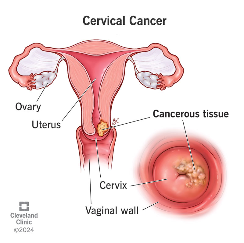 HPV Immunization in Adolescents: Emerging Ethical, Clinical and Public Health Questions